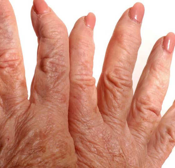 rheuma-arthritis_hand