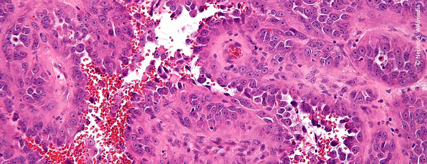 angiosarkom