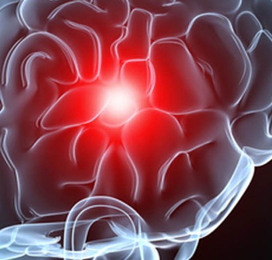 gehirn_hirnmetastase_hirnschlag