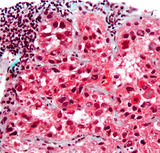 hepatocellular_carcinoma_intermed_mag