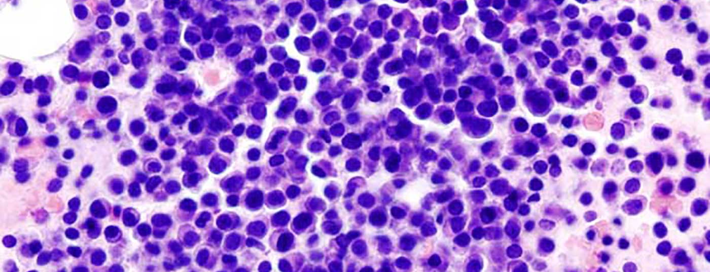 multples_myelom2