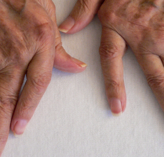 rheuma_arthritis_hand2