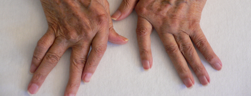 rheuma_arthritis_hand2