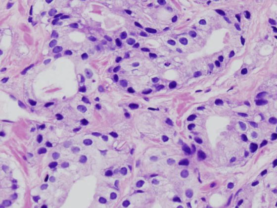 prostatakrebs_histo2