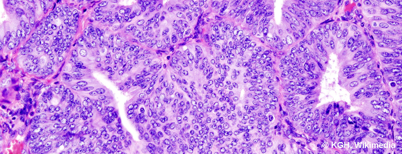 endometriumkarzinom