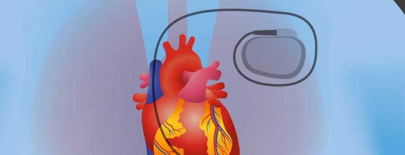 herzschrittmacher