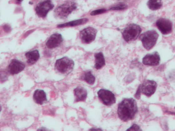 hodenkrebs_seminoma