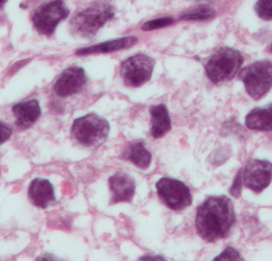 hodenkrebs_seminoma