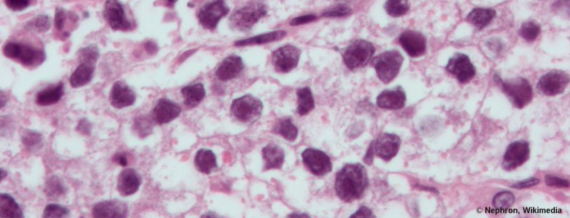 hodenkrebs_seminoma