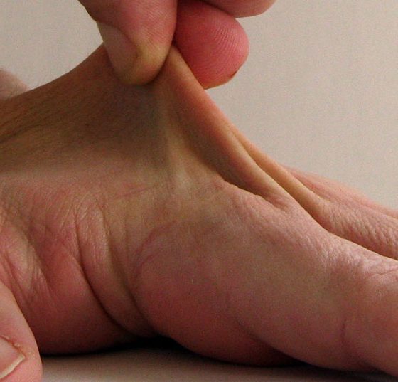 bindegewebsschwaeche