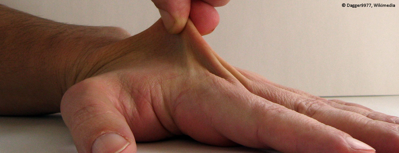 bindegewebsschwaeche