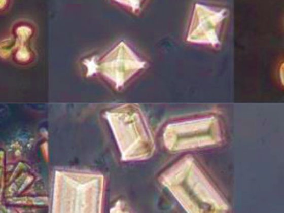 nierenstein-kristalle