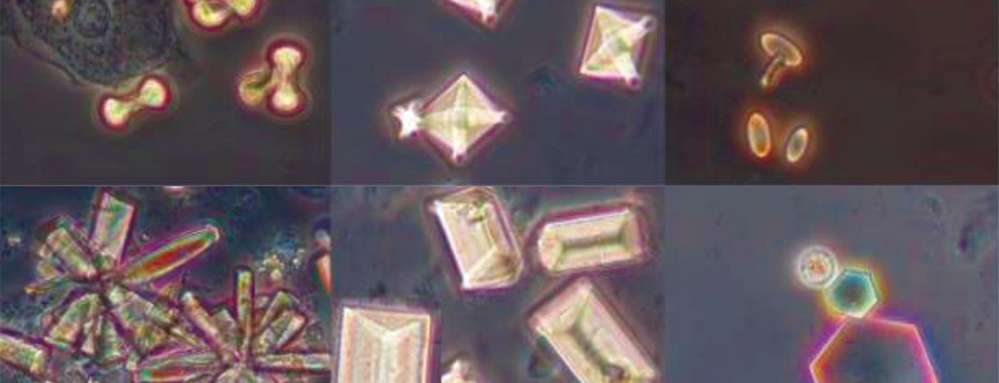 nierenstein-kristalle