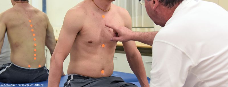 paraplegie