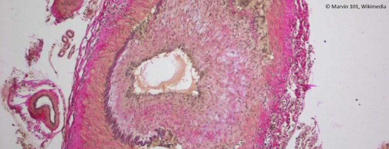 riesenzellarteriitis
