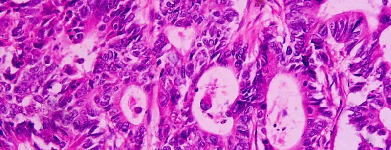 rektumkarzinom_wikipedia