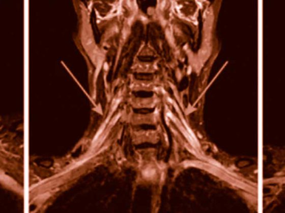 header_polyneuropathie