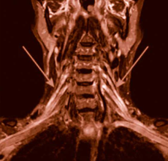 header_polyneuropathie