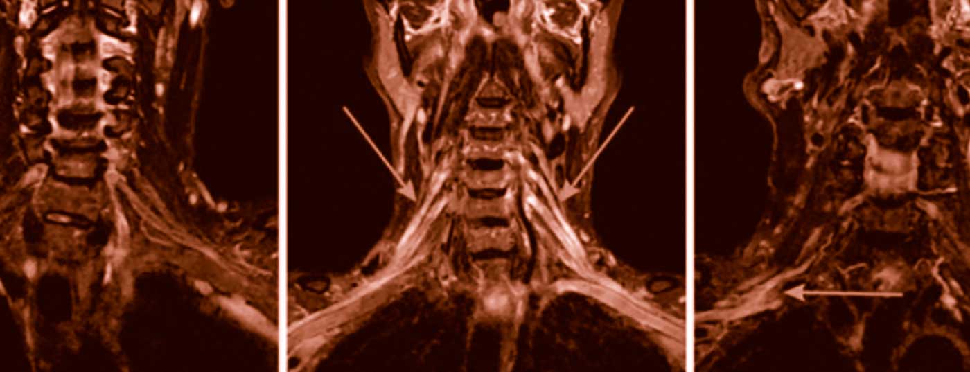 header_polyneuropathie