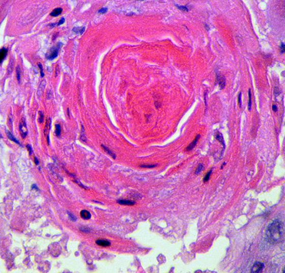 plattenepithelkarzinom_lungenkrebs