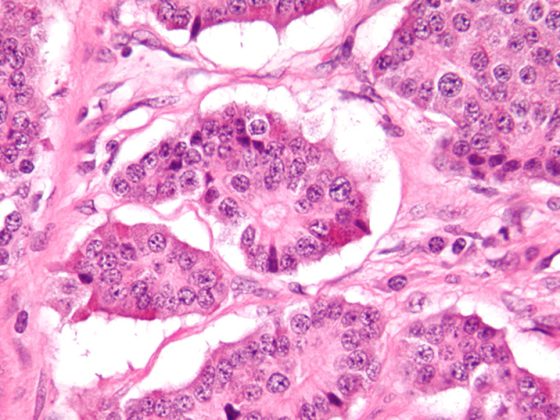 neuroendokriner-tumor