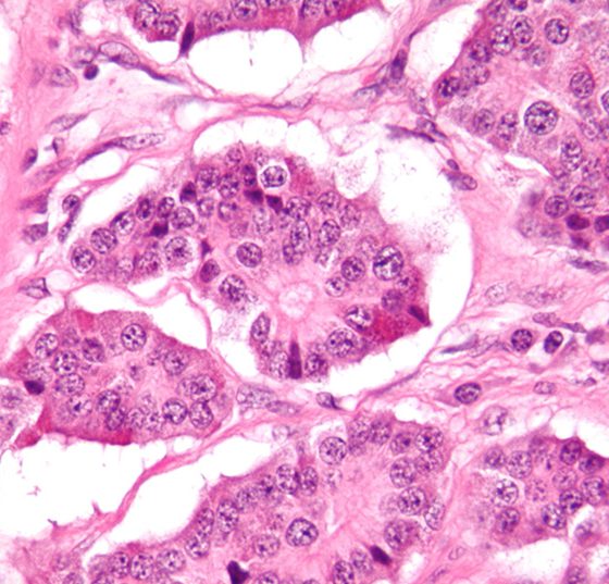 neuroendokriner-tumor