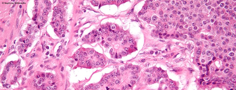 neuroendokriner-tumor