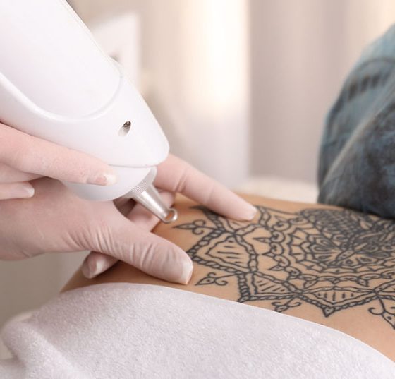 tattooentfernung