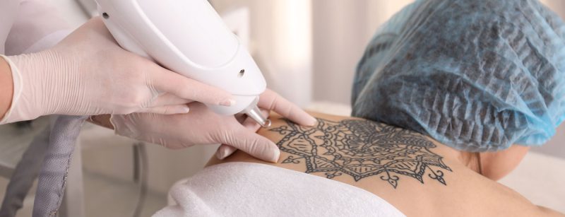 tattooentfernung