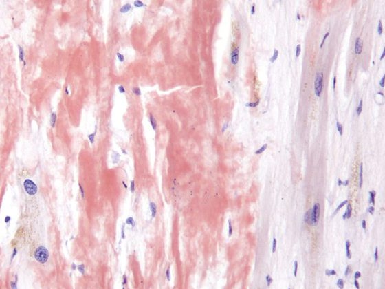 cardiac_amyloidosis_high_mag