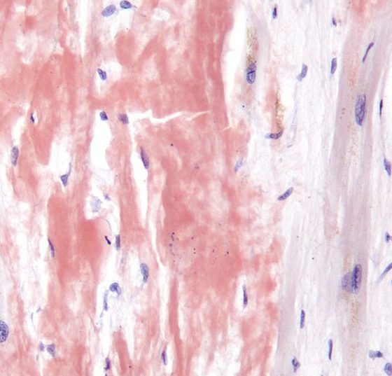 cardiac_amyloidosis_high_mag