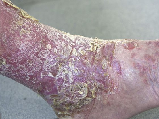 psoriasis3