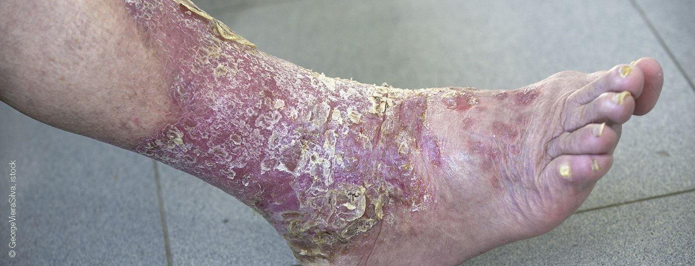 psoriasis3