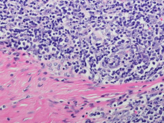 thymustumor_istock-599127854