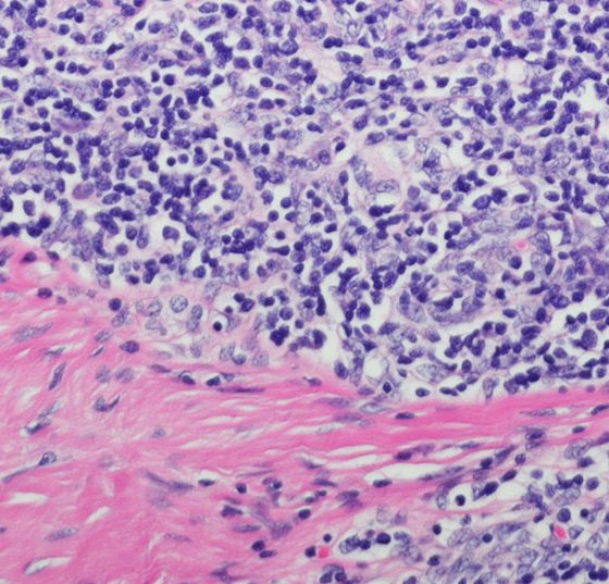 thymustumor_istock-599127854