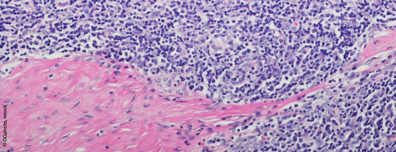 thymustumor_istock-599127854