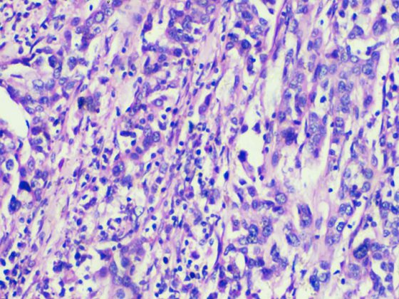 urothelkarzinom_istock