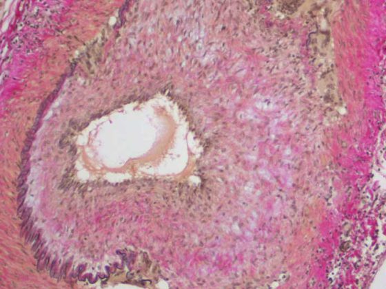riesenzellarteriitis