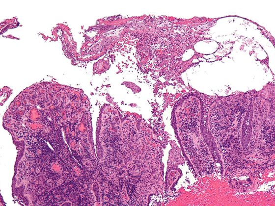 pemphigus_vulgaris_-_low_mag