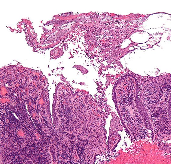 pemphigus_vulgaris_-_low_mag