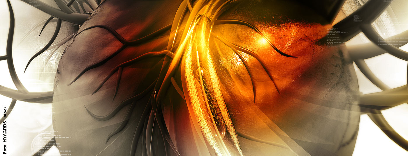 stent_istock-475746604