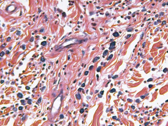 brustkrebs_istock_000011811683_medium