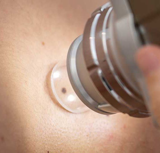 hautkrebs_istock-937239764