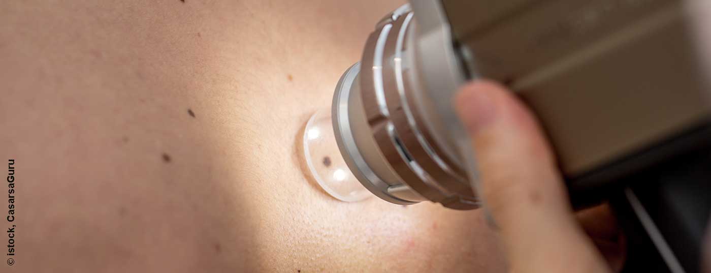 hautkrebs_istock-937239764