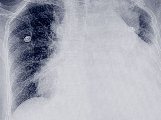 pleuraerguss_istock-952689296