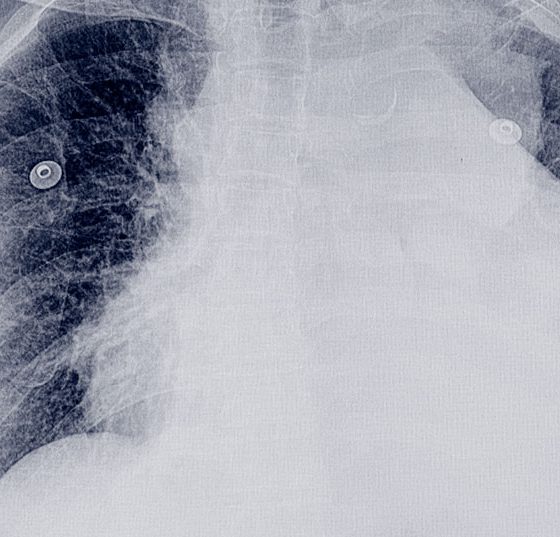 pleuraerguss_istock-952689296