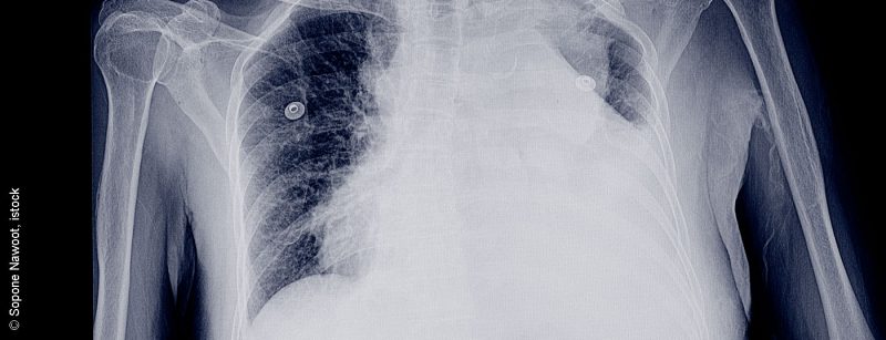 pleuraerguss_istock-952689296