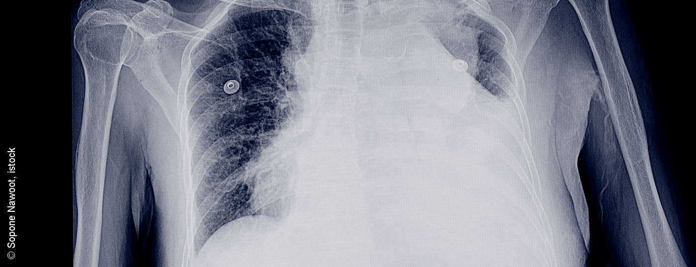 pleuraerguss_istock-952689296