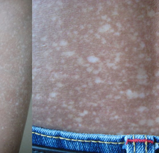 amyloidosis_cutis_dyschromica