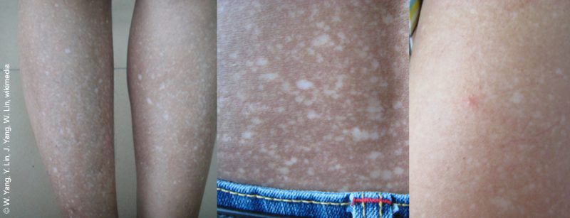 amyloidosis_cutis_dyschromica